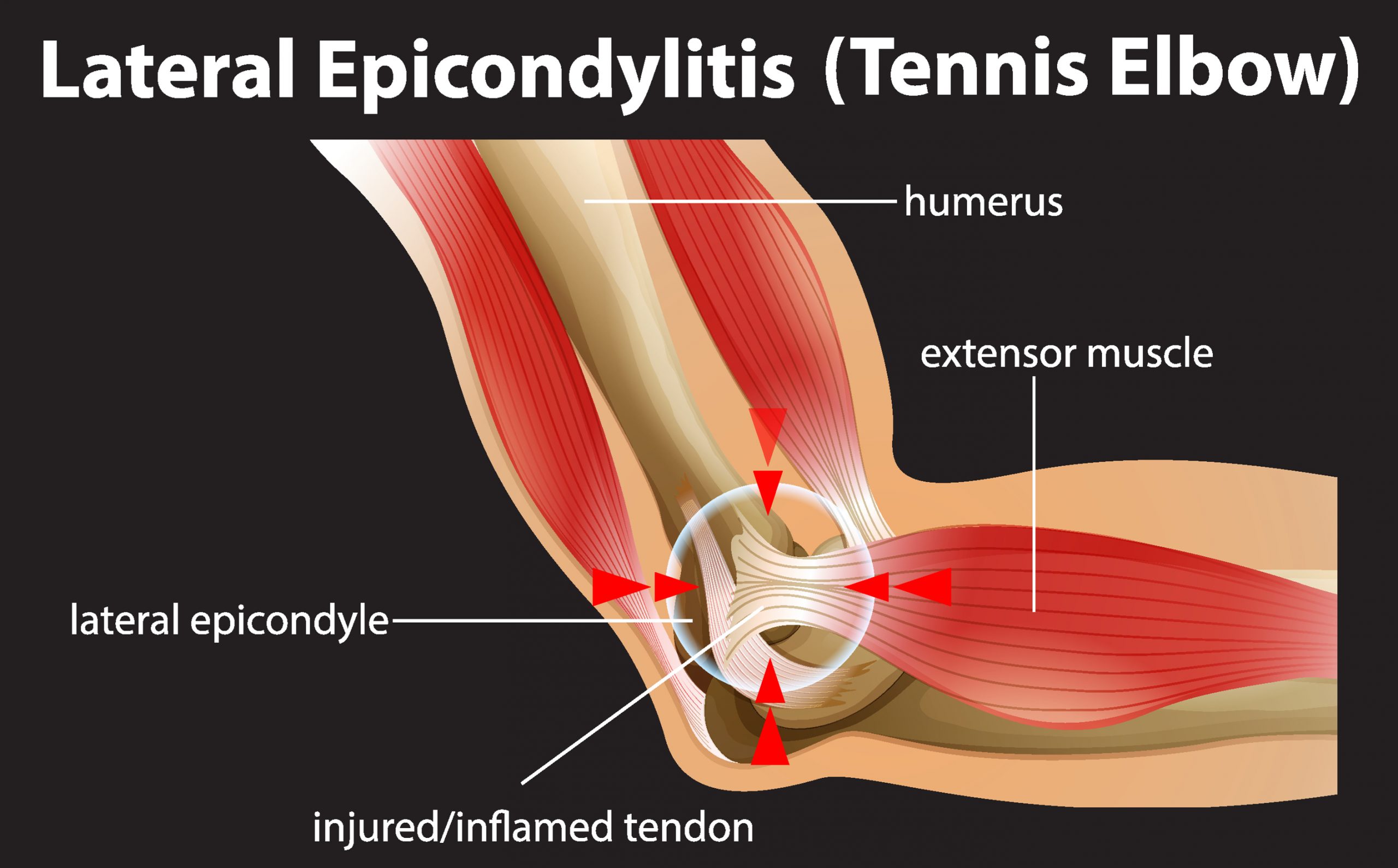 What Is Prolotherapy For Tennis Elbow In La Jolla?